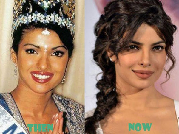 Priyanka Chopra Talks About The Plastic Surgery Of Her Nose, Priyanka