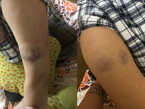 Subuhi Shares Pictures Of Her Injuries